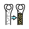 Osteoporosis